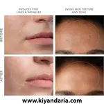 دستگاه پاکسازی میکرودرمابراسیون برند FOREO مدل Kiwi Derma. نمای دیگر