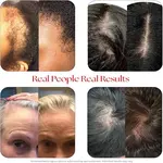 سرم پوست سر برند HAIRtamin نمای نتیجه